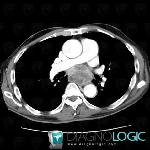 Cancer-l'oesophage, Oesophage, Scanner