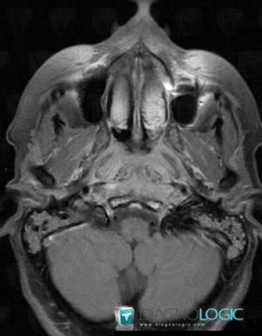 Cancer-nasopharynx, Espaces profonds de-face, IRM