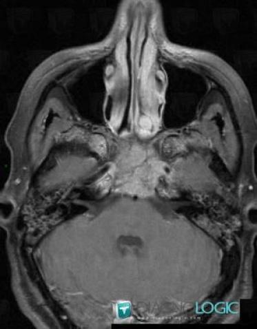 Cancer-nasopharynx, Fosses nasales / Nasopharynx, IRM