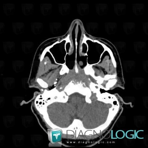 Cancer-nasopharynx, Fosses nasales / Nasopharynx, Scanner