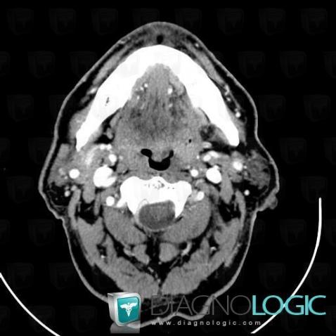 Cancer oropharyngé, Oropharynx / Plancher buccal, Scanner