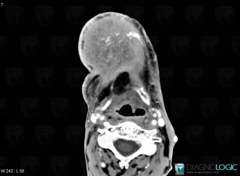 Cancer oropharyngé, Oropharynx / Plancher buccal, Scanner