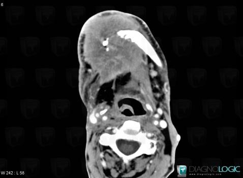 Cancer oropharyngé, Oropharynx / Plancher buccal, Scanner