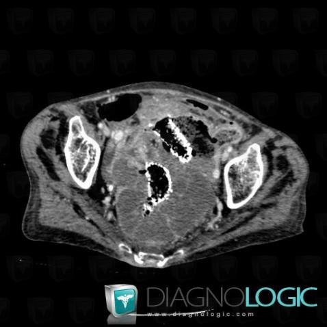 Cancer-sigmoïde, Colon, Scanner