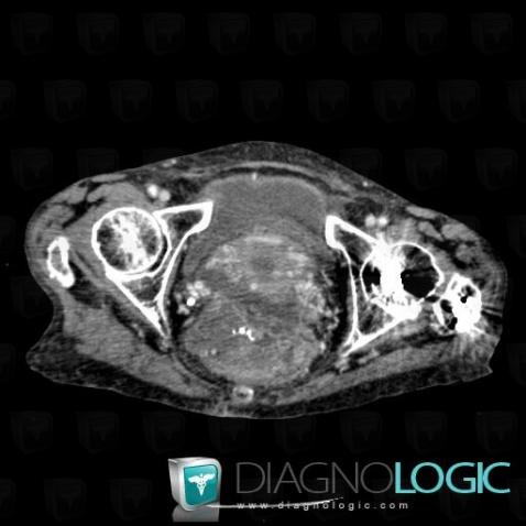 Cancer-sigmoïde, Pelvis / Périnée, Sacrum / Coccyx, Scanner