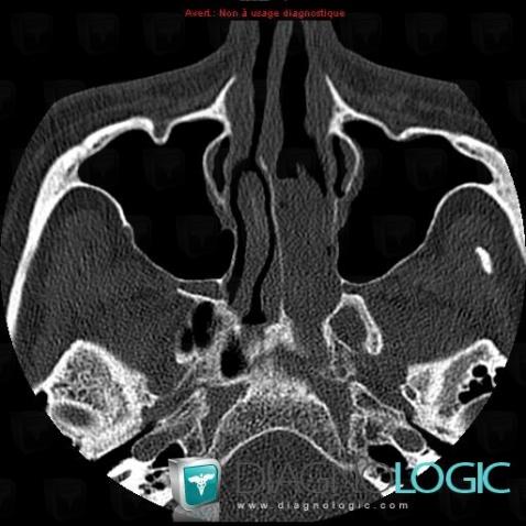 Cancer-sinus de-face, Fosses nasales / Nasopharynx, Scanner