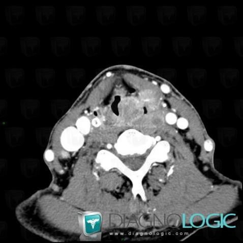 Cancer-sinus piriforme, Pharyngolarynx, Scanner