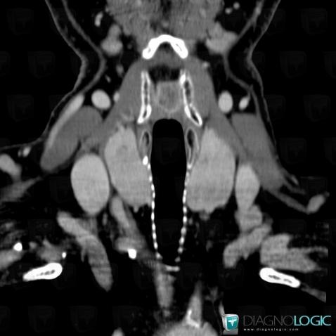 Cancer supraglottique, Larynx, Scanner