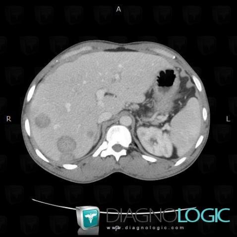 Candidiasis, Liver, Spleen, CT