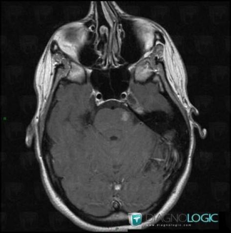 Capillary telangiectasia, Brainstem, Posterior fossa, MRI