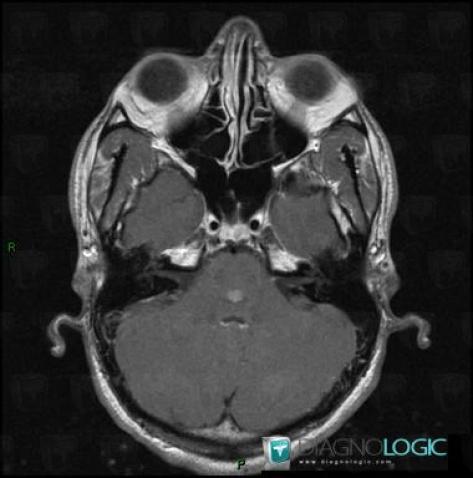 Capillary telangiectasia, Brainstem, Posterior fossa, MRI