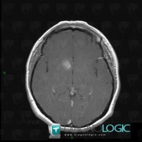 Capillary telangiectasia, Cerebral hemispheres, Basal ganglia and capsule, MRI