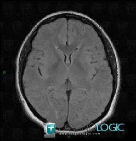 Capillary telangiectasia, Cerebral hemispheres, MRI