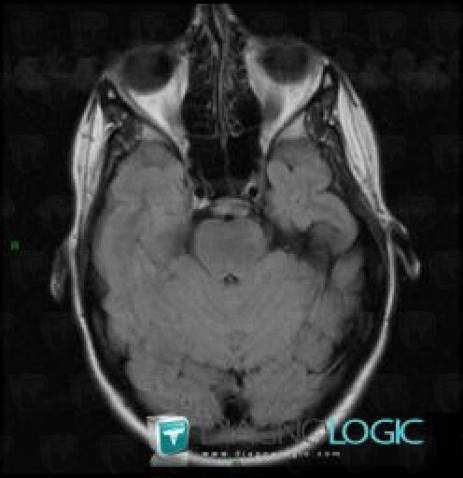 Capillary telangiectasia, Posterior fossa, MRI