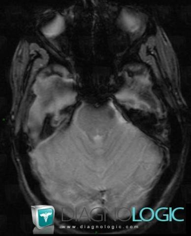 Capillary telangiectasia, Posterior fossa, MRI