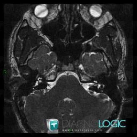 Capillary telangiectasia, Posterior fossa, MRI