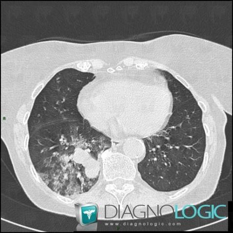 Carcinoid, Airways, CT