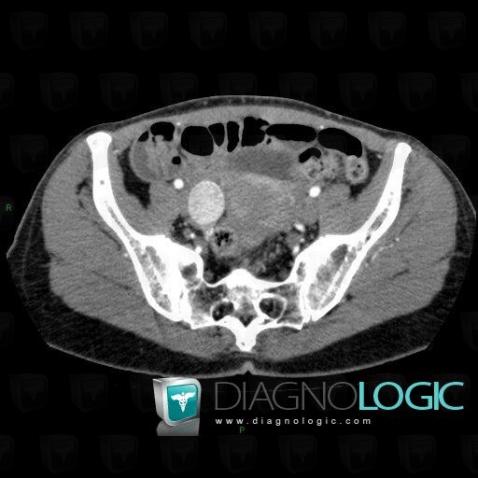 Carcinoid, Caecum / Appendix, CT