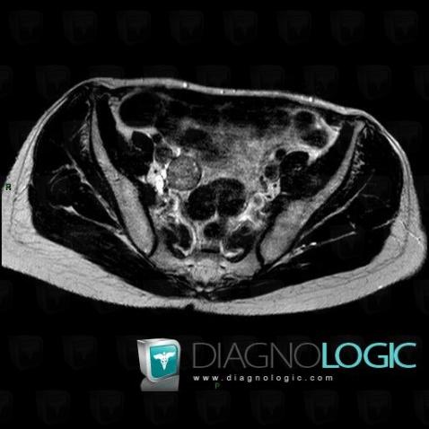 Carcinoid, Caecum / Appendix, MRI