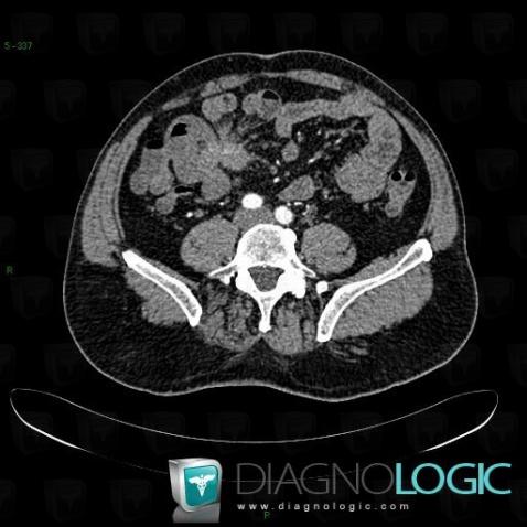 Carcinoid, Small bowel, CT