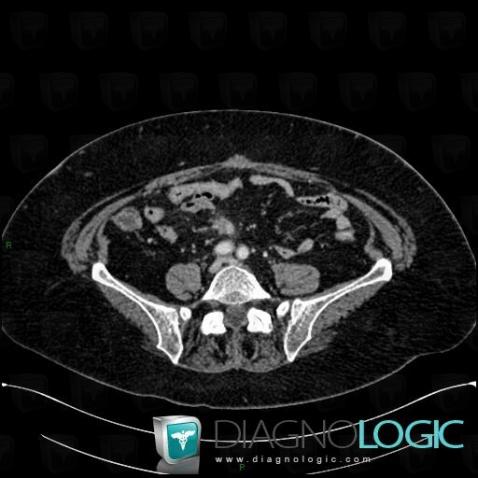 Carcinoid, Small bowel, CT