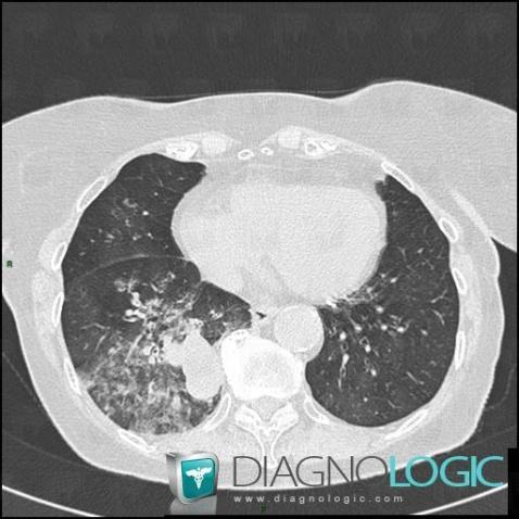 Carcinoïde, Parenchyme pulmonaire, Scanner