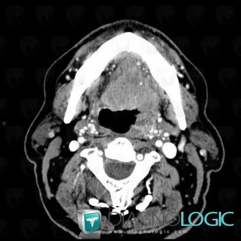 Carcinoma-base-tongue, Oropharynx / Floor-mouth, CT