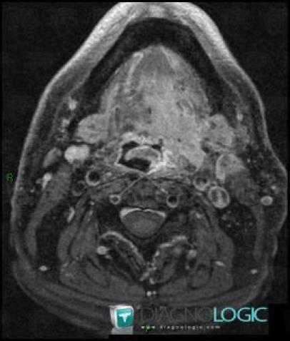 Carcinoma-base-tongue, Oropharynx / Floor-mouth, MRI