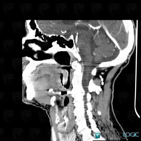 Radiology case : Carcinoma of soft palate (CT) - Diagnologic