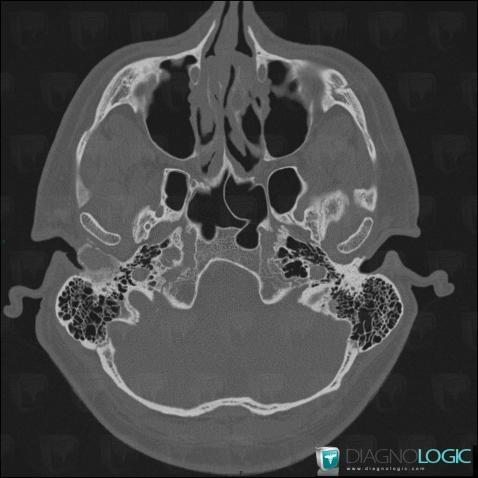 Carcinoma, Temporal bone, CT