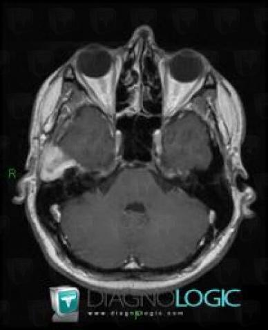 Carcinoma, Temporal bone, MRI