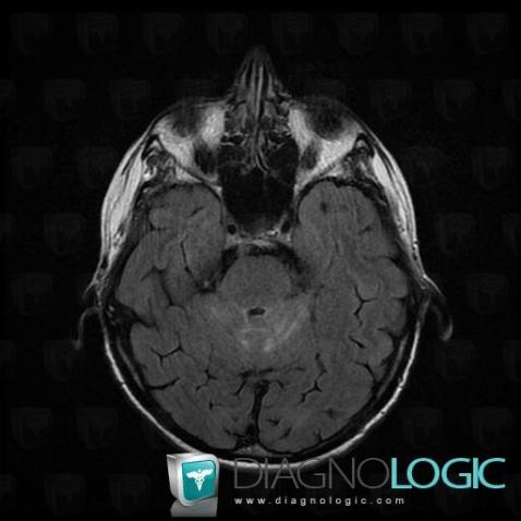 Carcinomatous meningitis, Cortico subcortical region, MRI