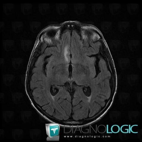 Carcinomatous meningitis, Cortico subcortical region, MRI