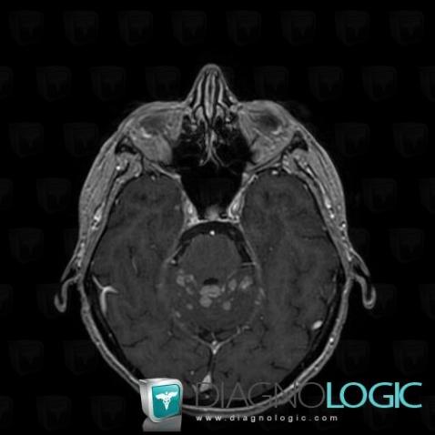 Carcinomatous meningitis, Infratentorial peri cerebral spaces, MRI