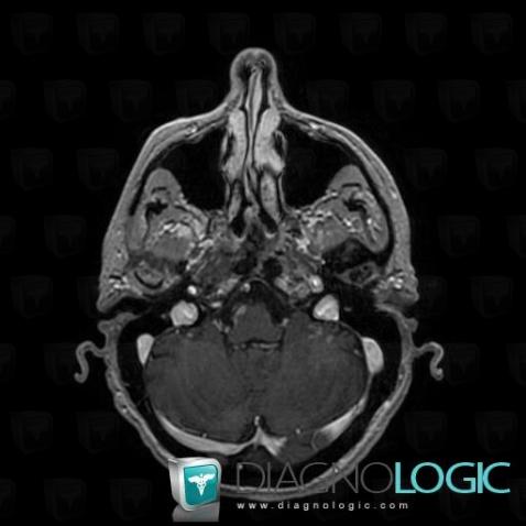 Carcinomatous meningitis, Infratentorial peri cerebral spaces, MRI