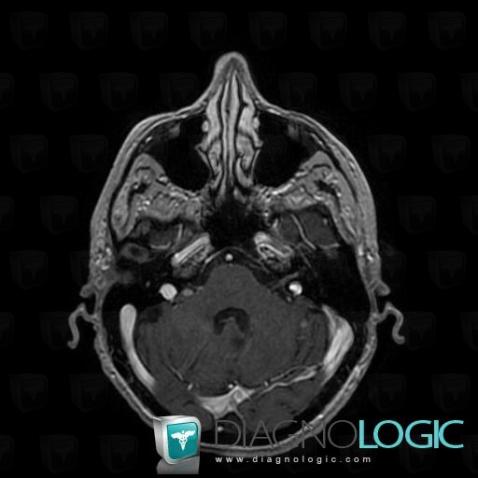 Carcinomatous meningitis, Infratentorial peri cerebral spaces, MRI