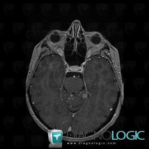 Carcinomatous meningitis, Infratentorial peri cerebral spaces, MRI