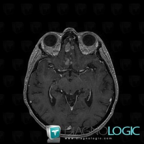 Carcinomatous meningitis, Supratentorial peri cerebral spaces, Cortico subcortical region, MRI