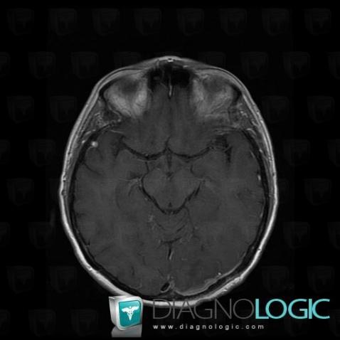 Carcinomatous meningitis, Supratentorial peri cerebral spaces, MRI