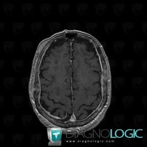 Carcinomatous meningitis, Supratentorial peri cerebral spaces, MRI