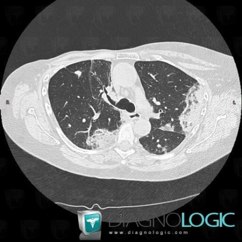 Carcinome bronchioloalvéolaire, Parenchyme pulmonaire, TDM