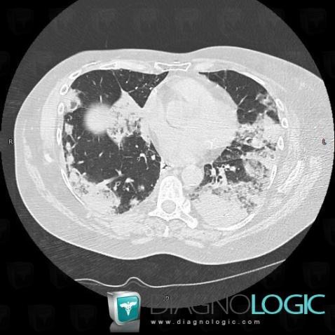 Carcinome bronchioloalvéolaire, Parenchyme pulmonaire, TDM