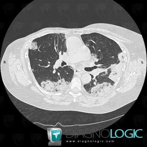 Carcinome bronchioloalvéolaire, Parenchyme pulmonaire, TDM