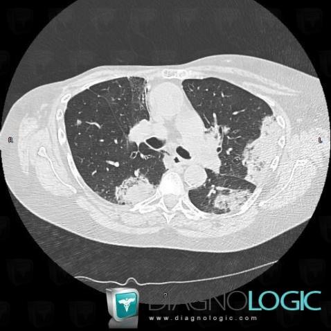 Carcinome bronchioloalvéolaire, Parenchyme pulmonaire, TDM