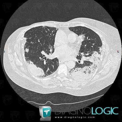 Carcinome bronchioloalvéolaire, Parenchyme pulmonaire, TDM