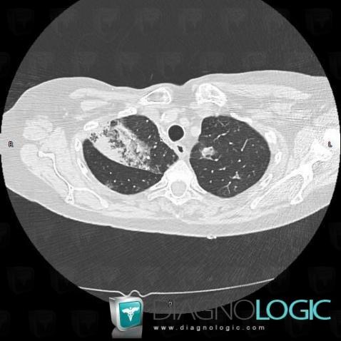 Carcinome bronchioloalvéolaire, Parenchyme pulmonaire, TDM