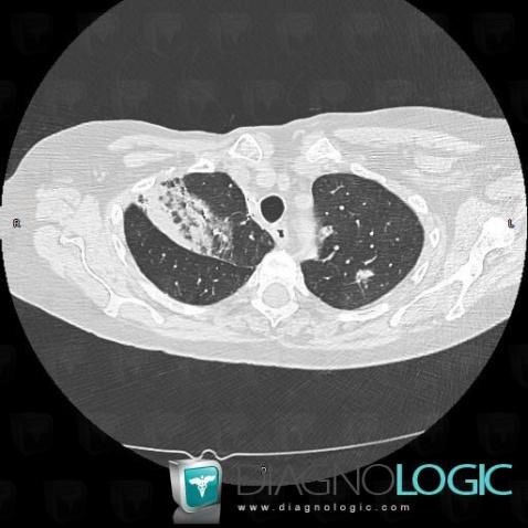 Carcinome bronchioloalvéolaire, Parenchyme pulmonaire, TDM