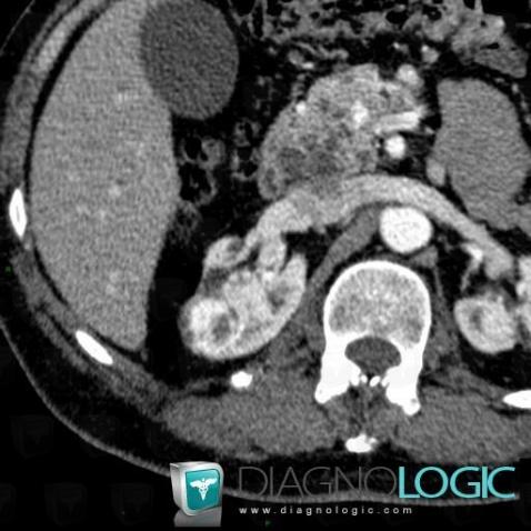 Carcinome-cellules claires, Rein, Scanner