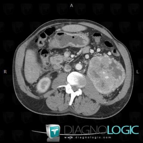 Carcinome-cellules claires, Rein, Scanner