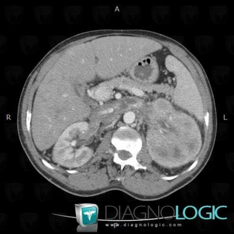 Carcinome-cellules claires, Rein, Scanner